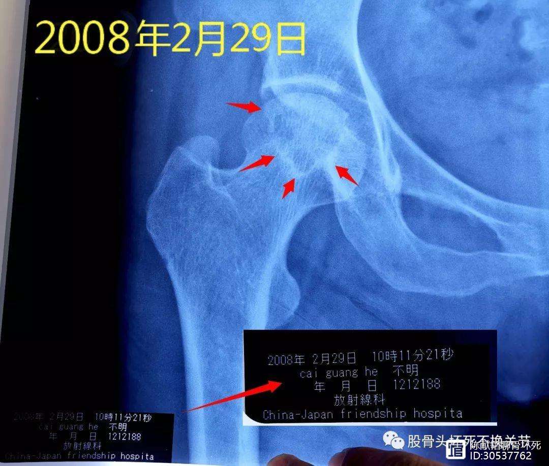 汕头人工骨头医保报销多少(人工骨头医保报销多少比例)
